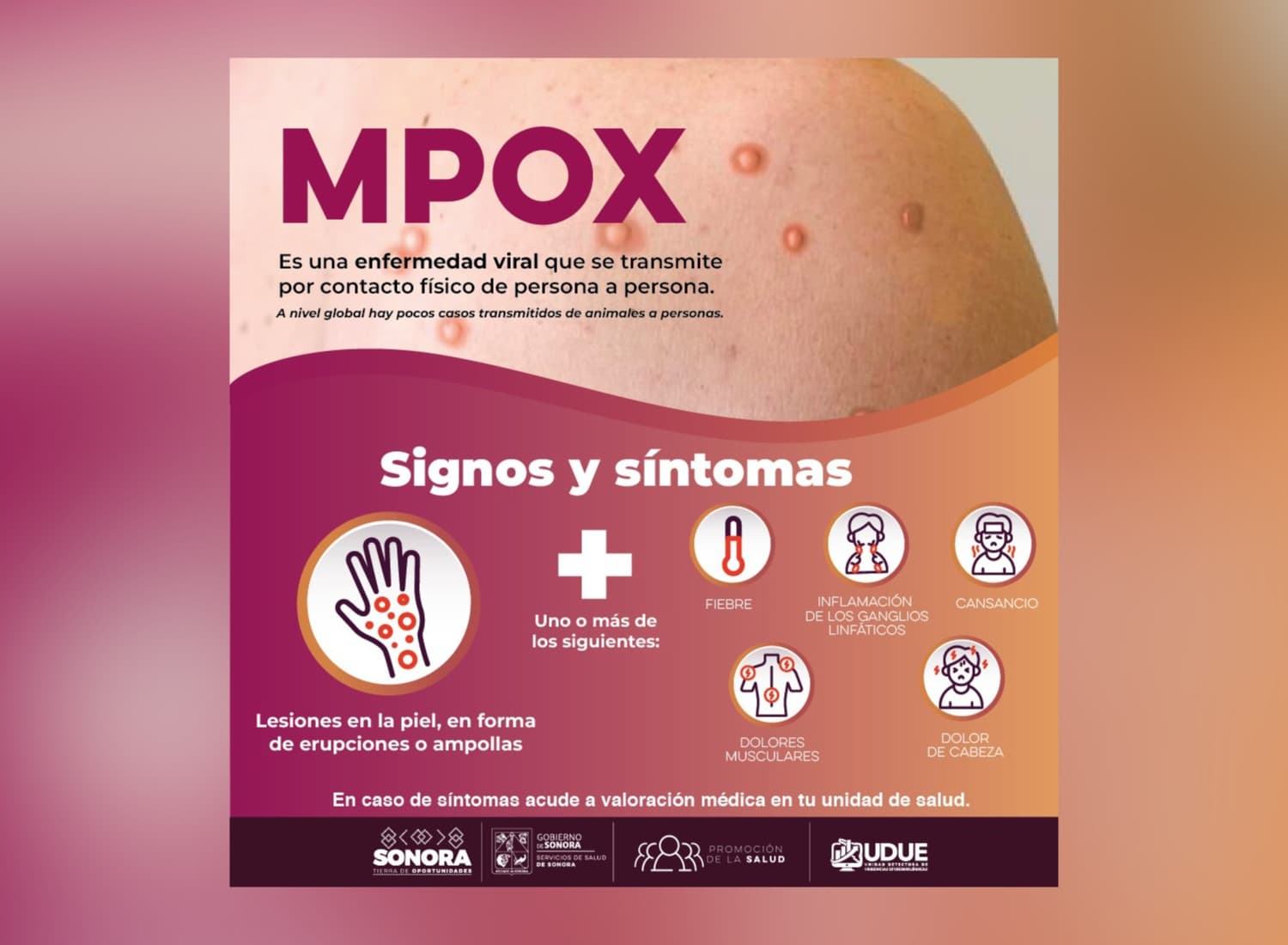 Sonora permanece con 2 casos importados de Mpox; sin casos autóctonos